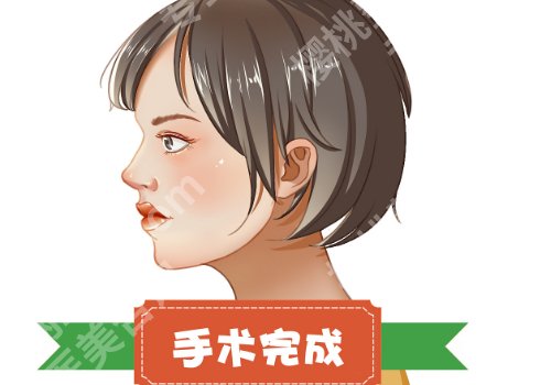 徐永丰缩鼻翼价格多少?低至1.5w起,附案例分享~