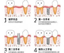 湖州市口腔医院种植牙价格贵不贵？收费表展示！看完不踩坑