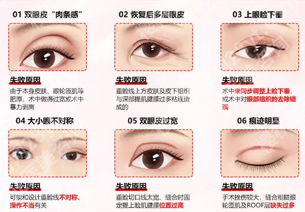 王滨福双眼皮案例图鉴赏！做双眼皮技术好吗？2026亲测案例分享