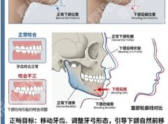 洛阳牙齿矫正收费标准怎么样！具体项目价格表新鲜出炉！