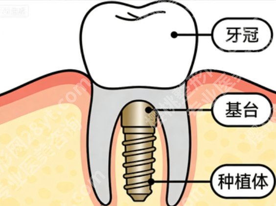 秦皇岛全口种植牙哪家好？能做全口的靠谱机构终于整理出来了