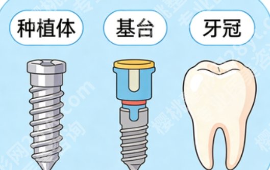 宜宾全口种植牙哪家好？当地做全口靠谱的机构公布，想做的先了解