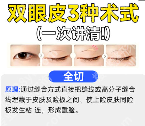 顾新安做双眼皮好吗?医生详情、坐诊医院及26年价格分享!