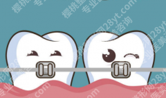 沧州牙齿矫正多少钱？金属托槽、陶瓷半隐形、隐形牙套费用区间全整理