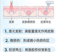 葫芦岛点阵激光多少钱？价格在3k到1w不等含可靠医院推荐！