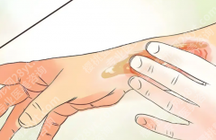 淮安祛疤比较好的医院怎么找？疤痕修复别盲选，关键要看这几点