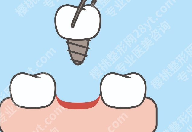西宁种牙哪家医院好？看机构资历，也要看方案和术后管理