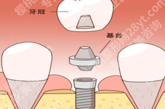 泰安种牙哪家医院好?热门医院名单公开,单颗缺牙到半口修复都能参考
