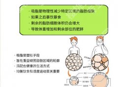 罗明生吸脂的口碑评价怎么样？本地吸脂专家实力分析来袭！