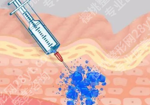 惠州哪里有打除皱注射的？正规医院清单+4大避坑tips公开