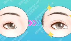 上海双眼皮手术哪家医院比较好？术式、医生审美和修复能力都要看
