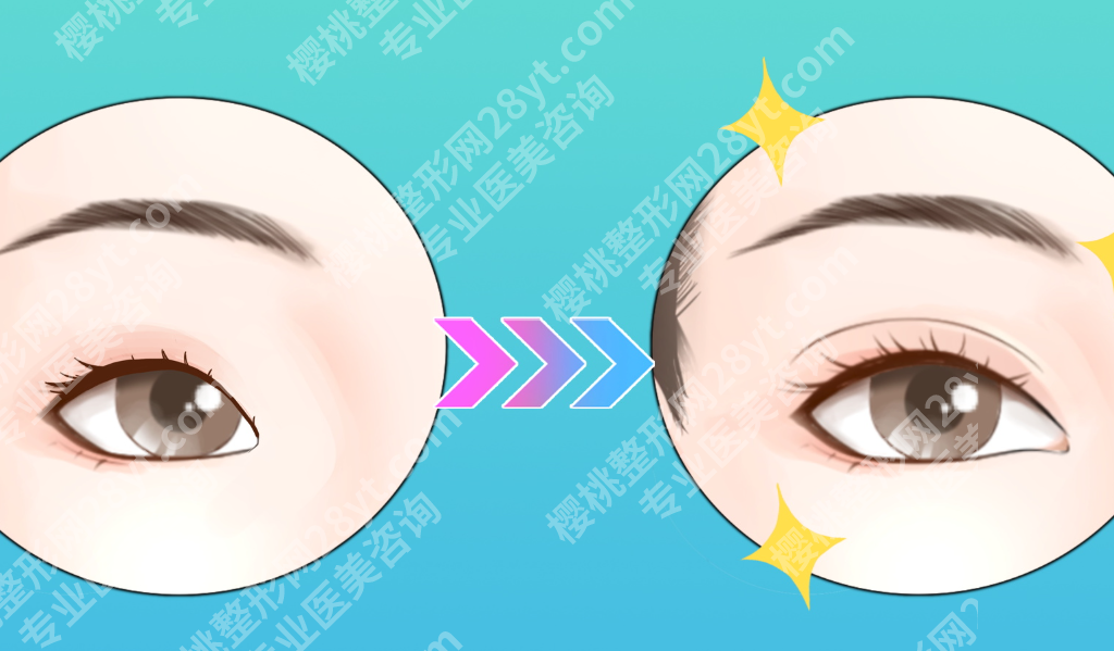 上海双眼皮手术哪家医院比较好?术式、医生审美和修复能力都要看