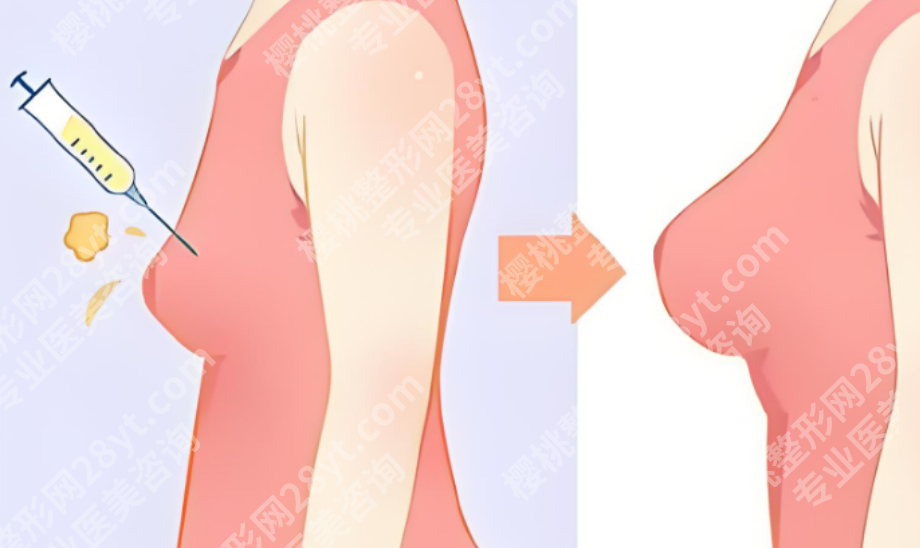 上海乳房整形医院哪好?想做隆胸、缩胸、修复的人先收藏