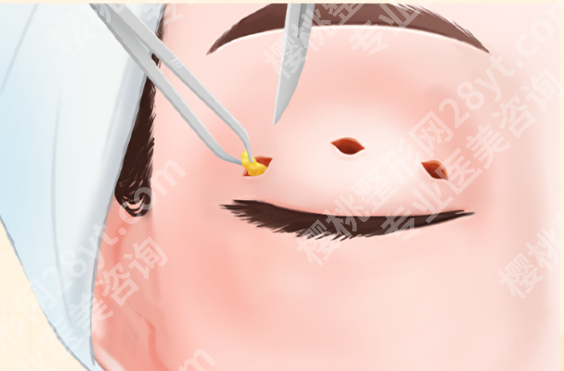 在上海割双眼皮好的医院哪家好？肿眼泡、内双、眼皮松弛怎么选