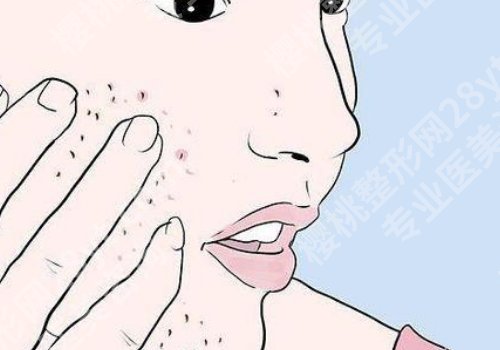 佛山祛痘机构哪里好？一文了解多家热门医院、这几家藏不住了！