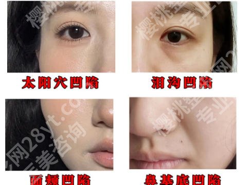 兰州哪里脂肪填充做得好？五家硬核医院名单公布！
