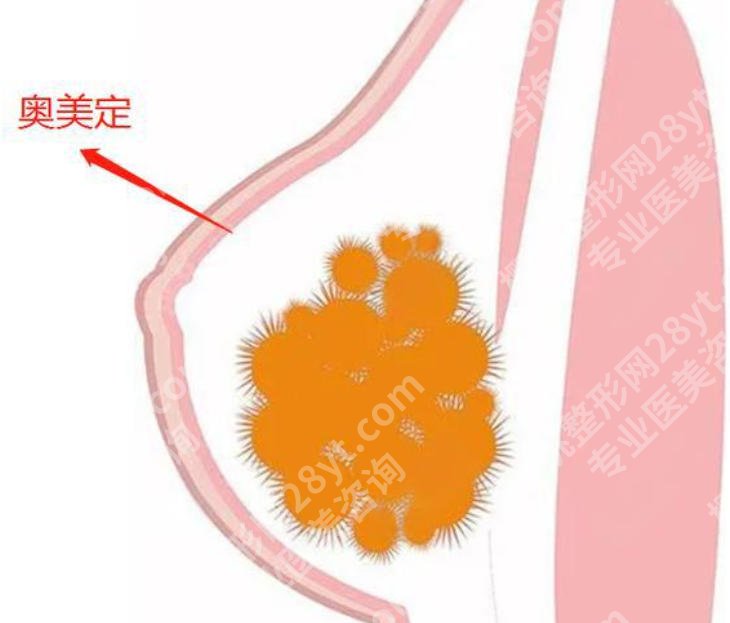 厦门注射隆胸奥美啶取出医院有哪些医生？陈隽鹏/张帆等医生审美高