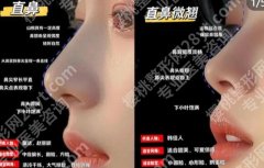 兰州注射隆鼻费用贵不贵？价格表更新！含人气医院名单