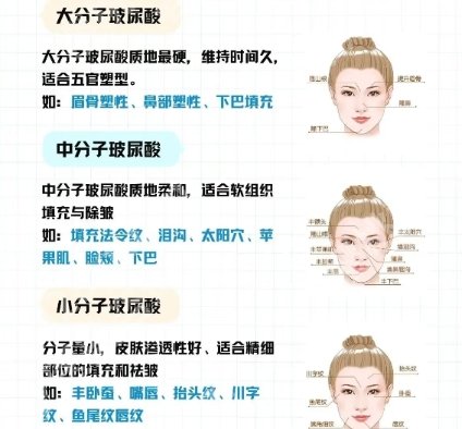 广州注射下巴要多少钱?2026价格表揭晓!含医院名单
