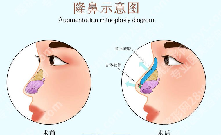 常州注射隆鼻哪里做得好？这几家口碑机构放心选！
