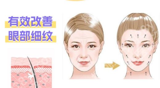 成都注射医生李哲远技术如何？除皱经典案例展示！