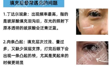 南宁自体填充泪沟哪里好？2026医院排行榜公布！