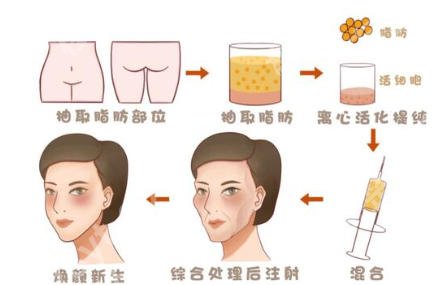 大连自体脂肪填充医生哪个好?李研、赵穆欣口碑在线!