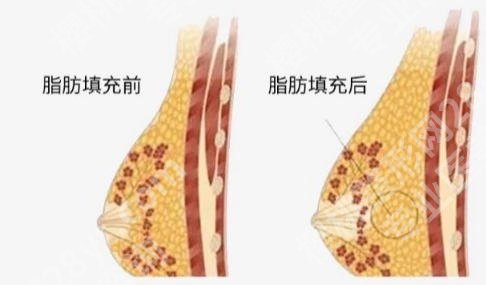 南宁注射丰胸医院名单揭晓！这份避坑指南请收好