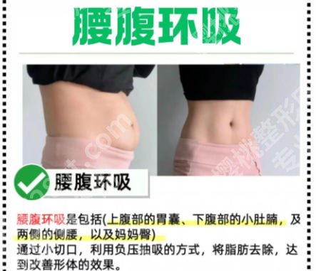 上海第九人民医院吸脂怎么样？技术优势剖析！含经典案例