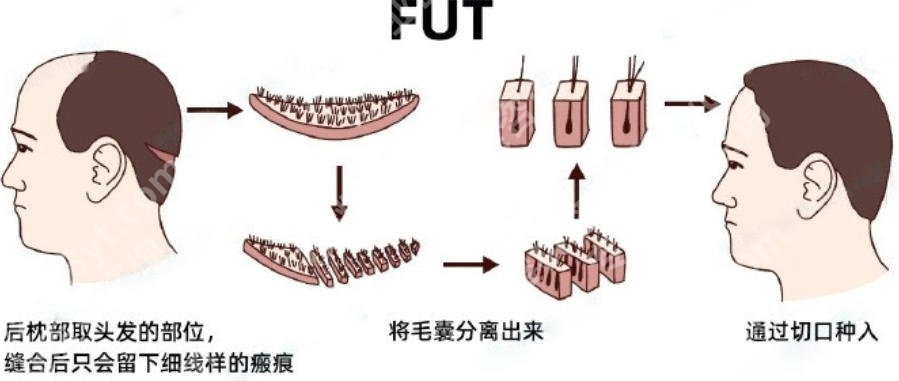 静安区中心医院植发科怎么样？植发项目技术优势剖析！