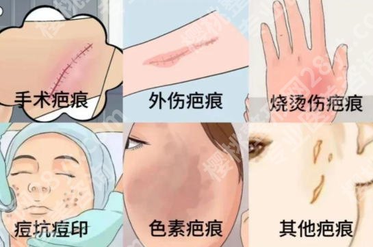 上海八院去疤怎么样?黄杰、陈炜医生实力在线!含价格表