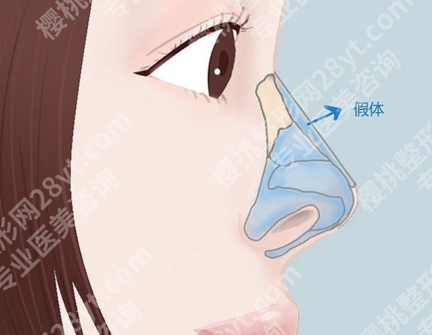 金华中心医院做鼻子手术费用贵不贵？硅胶、假体、耳软骨等价格有所区别！
