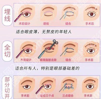 上海华东医院整形科好不好?推荐项目公布!双眼皮4k左右!