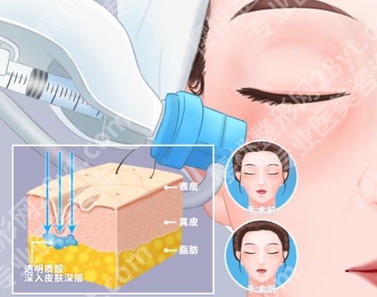 宁波第一医院除皱打一次多少钱?价格点评！技术优势测评