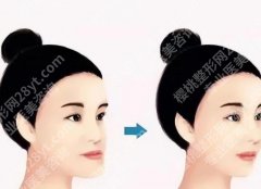 上海六院正颌手术费用贵不贵？正颌6w左右！含项目介绍