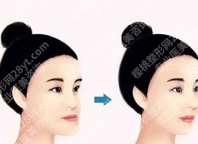 上海六院正颌手术费用贵不贵？正颌6w左右！含项目介绍