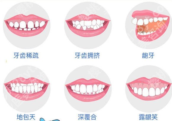 蚌埠二院牙齿矫正技术如何？托槽矫正8k-2w不等！透明收费更放心