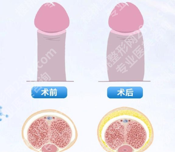 上海延长手术张权医生怎么样？用户口碑真实附上！含医生简介