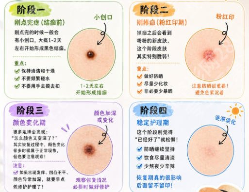 中山大学附属第一医院激光点痣多少钱？真实案例分享+价格明细大公开