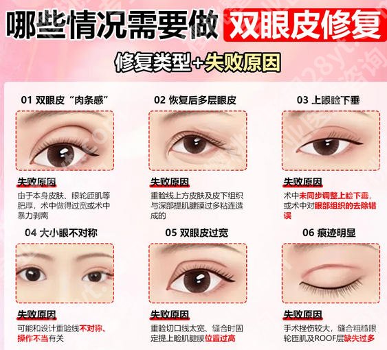 遵义双眼皮修复医院名单汇总！整理一份靠谱机构名单