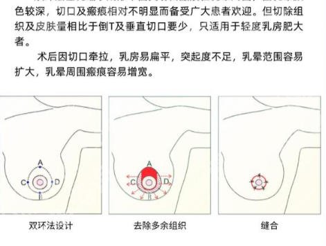 杭州缩胸手术好医院有哪些？这些医院都是口碑甄选！