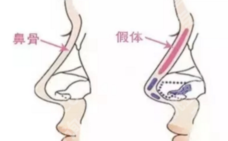上海第九人民医院隆鼻多少钱？材料差异带来的价格波动说明白