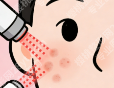 空军总医院皮肤科光子嫩肤：治疗次数与效果维持时间答疑