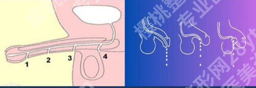 武汉可以做延长术的医院有哪些？正规医院名单揭晓