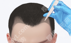 中国医大一院植发好吗？技术路线和适合人群说清楚