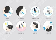 徐州三院植发怎么样？真人案例过程一一了解
