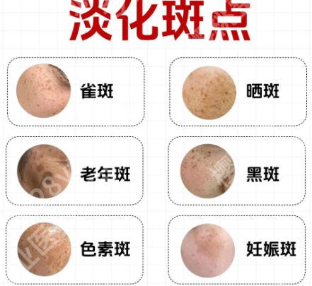 浙江省中医院美容科车菲怎么样？2026祛斑案例展示！