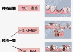 沙井人民医院种牙多少钱？2026新收费表与坑指南来了