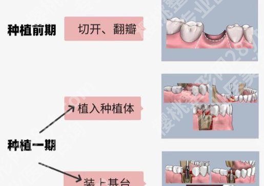 沙井人民医院种牙多少钱？2026新收费表与坑指南来了
