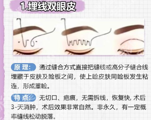 广州南方医院双眼皮好吗？医院实力、热门项目往这看